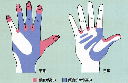 ノロウイルスの感染予防と手洗い